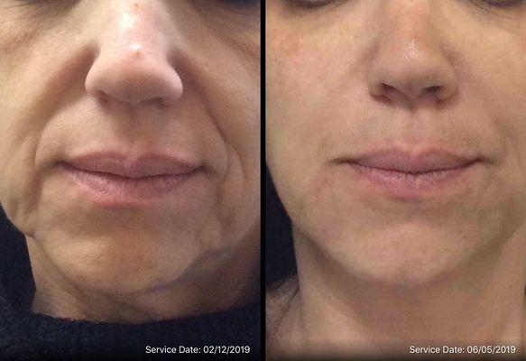 Before and after filler treatment