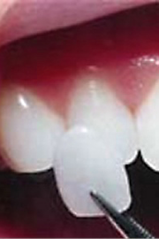 Porcelain Veneers make any smile pearly white!