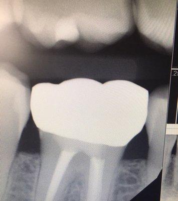 Well fitting crown after root canal therapy.