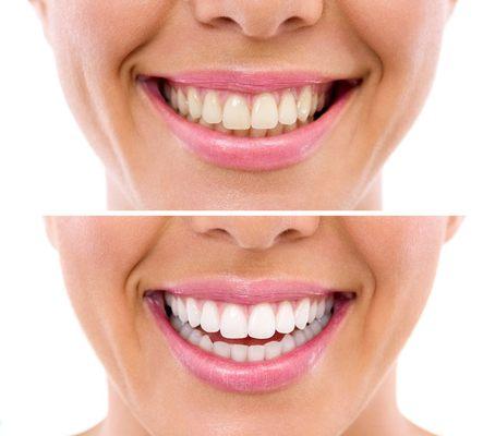 Cosmetic Dentists | Teeth whitening in Valley Village CA