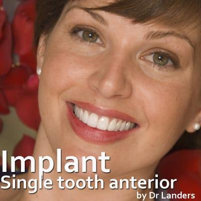 Single tooth Implant replaced upper rt central. Surgical placement of Implant, oral plastic surgery, & Porc Crown by Dr Landers