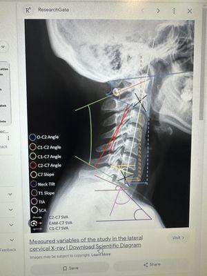 Researching Cervical Spine measurements and methods.