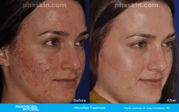 MicroNeedling Treatment