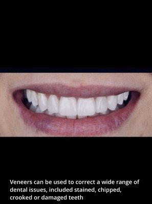 beautiful smile can achieved with ceramic veneers