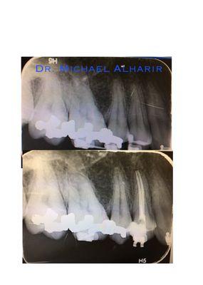 Root canal for upper first premolar, 2 canals.