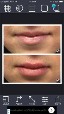 Beautiful and natural lips using Juvederm filler.