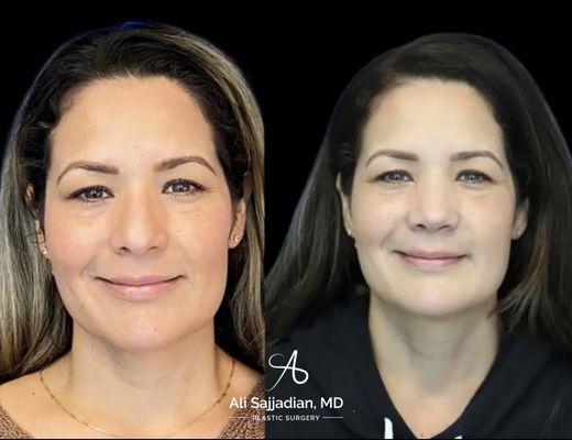 Before and After | Surgical Rhinoplasty