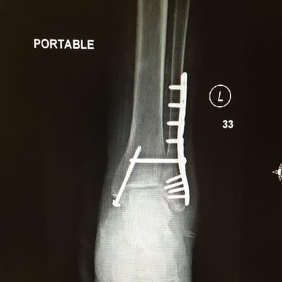 Ankle fracture