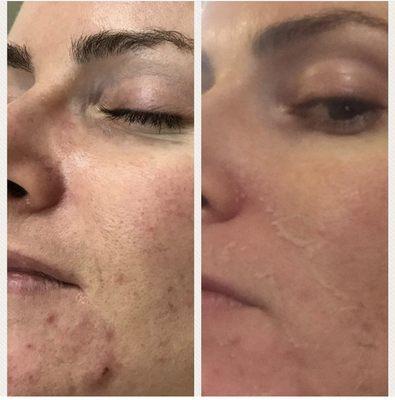 Before and 6 days after a TCA peel to treat acne, scarring, fine lines and wrinkles