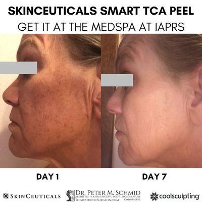 SkinCeuticals Smart TCA Peel Before After by Alithia