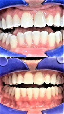 Top is before, 
 bottom is after.
 
 Unfortunately, the after pic doesn't accurately show the positive effects of the teeth whitening