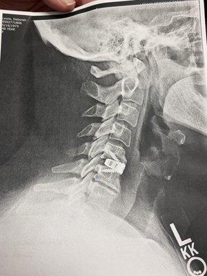 Cervical spine with disk replacement