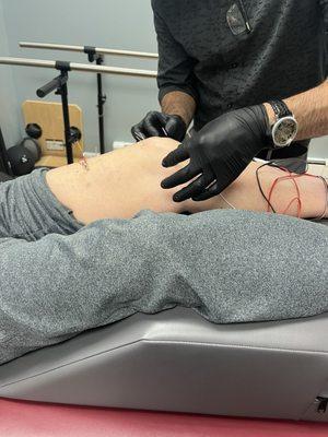 Dry needling for arthritic knee pain.