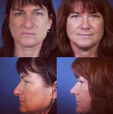 Rhinoplasty before and after