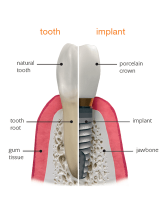 Straumann Implant Dentist