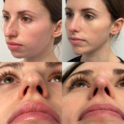 One month after chin augmentation and rhinoplasty