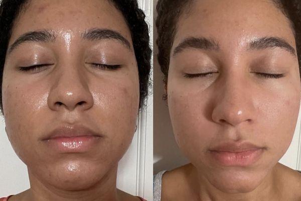 Discover the power of MicroNeedling: see amazing before and after results. Transform your skin today!