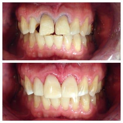 Bonding Veneer to reshape the teeth and closing the gap. Minimal dentist intervention and same day dentistry