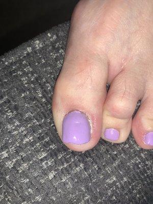 Terribly done toe nail