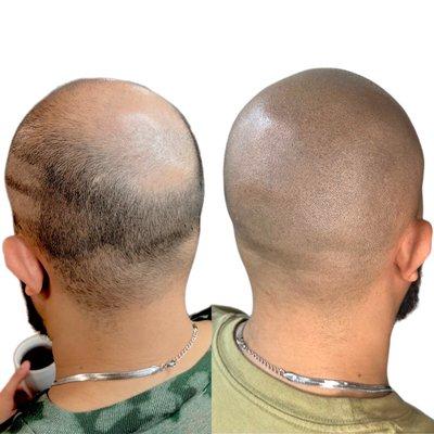 Scalp Micropigmentation before and after