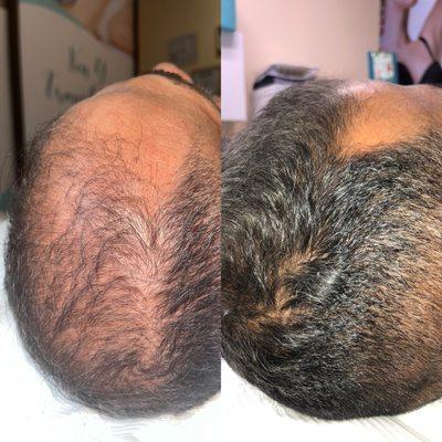 PRP alopecia treatment