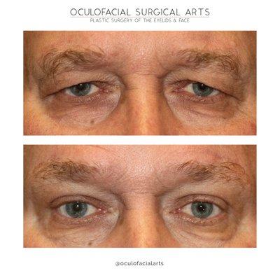 Male Blepharoplasty & Brow Lift.