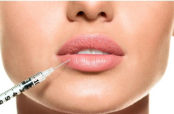 Lip Filler