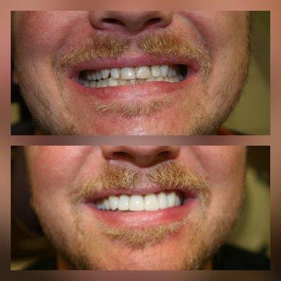 Before & After Veneers