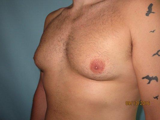 Before male breast reduction (gynecomastia) Patient A