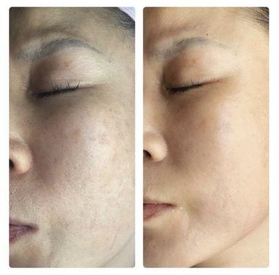 Microneedling to reduce the appearance of fine lines and pores