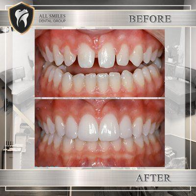 alternative to braces closing the bite and spacing with veneers