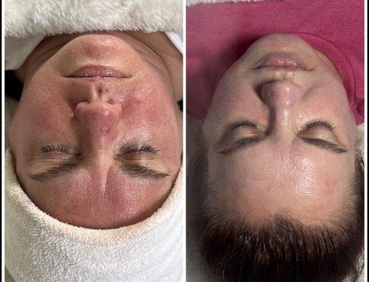 Microneedling with our secret combo method for rosacea.