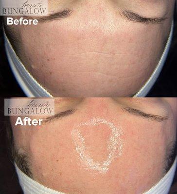 Before and after HydraFacial Syndeo (Platinum HydraFacial)