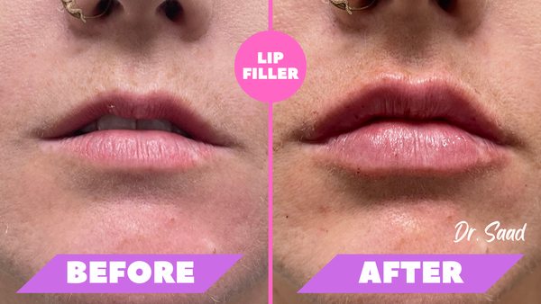 Lip filler.