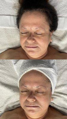 Anti aging facial