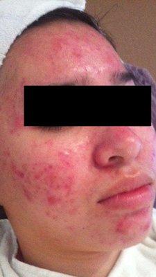 Client before acne treatments and home care began.