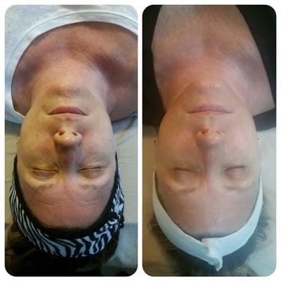 Micro Current Face Lift Therapy