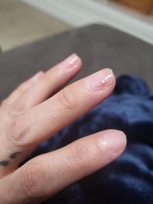 I had to clip my own nails and added polish to try and avoid any infection. The red parts are holes on my nails.