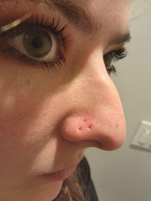 Healed piercing holes