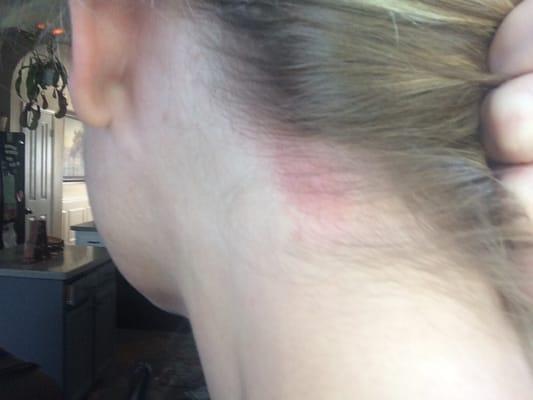 Curling iron burn from Rima at Greatclips.