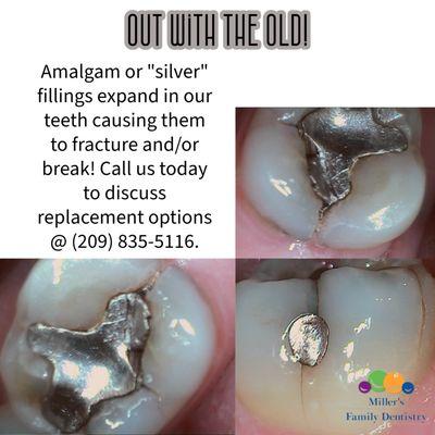 Besides looking a little funky, silver fillings of this size can cause damage to your teeth over time.