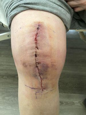 Right Knee replacement