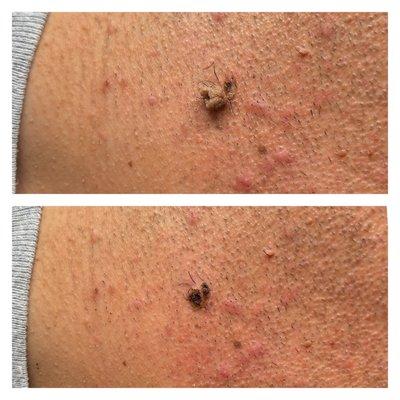 wart/skin tag removal