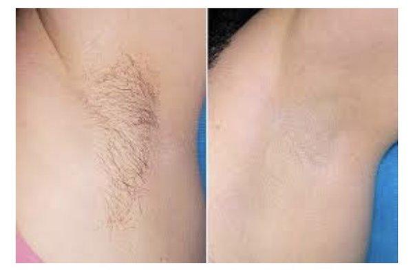 Laser Hair Removal