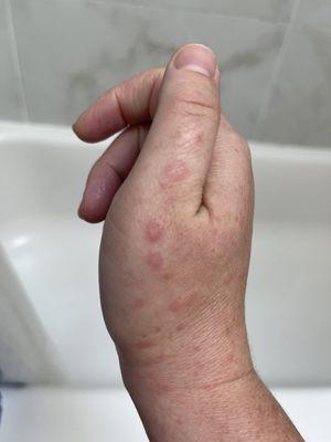 Hives that were apparently not concerning.