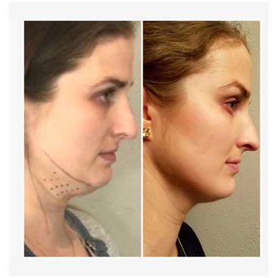 Bye bye double chin with Kybella