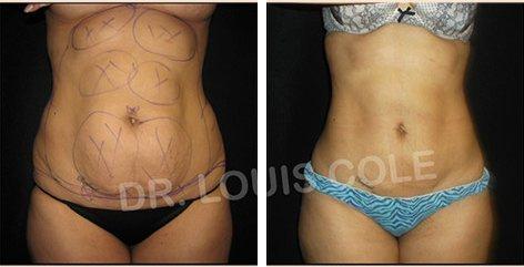 Liposuction