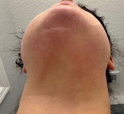 Scar under chin from second lipo procedure