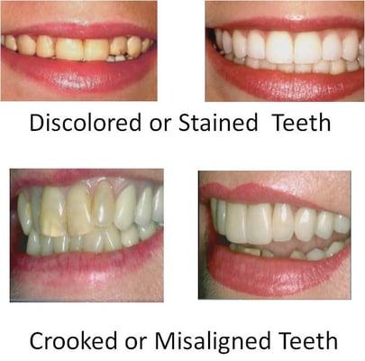 Discolored and Crooked Teeth