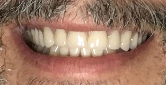 My teeth after Dr. Holm did his magic!!!